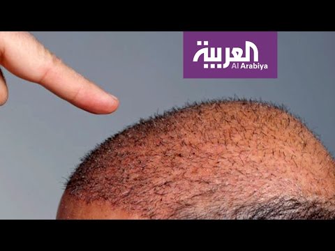 شاهد تقنية جديدة لزراعة الشعر دون جراحة