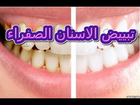 وصفة مذهلة لتبييض الأسنان وإزالة الاصفرار