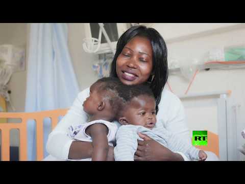 أطباء ينجحون في فصل توأمين سياميين موصولتين عند مستوى الجمجمة