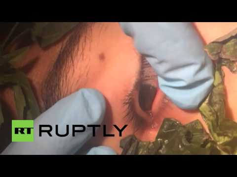 فيديو الأطباء يزيلون دودة من عين صبي في بيرو