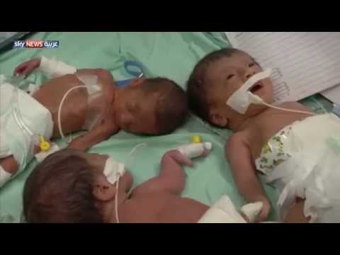 13 مليون طفل خدج يولدون سنويًا