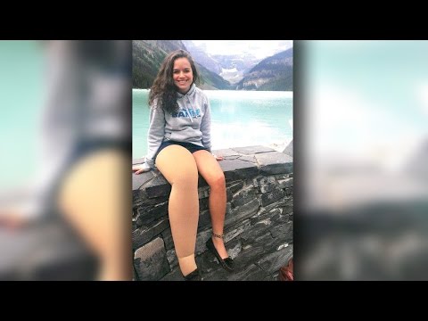 مراهقة تتحدى حجم ساقها الضخم