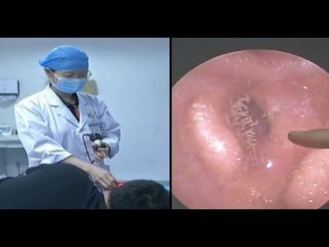 طبيبة صينية تنزع مئات الديدان من أذن رجل