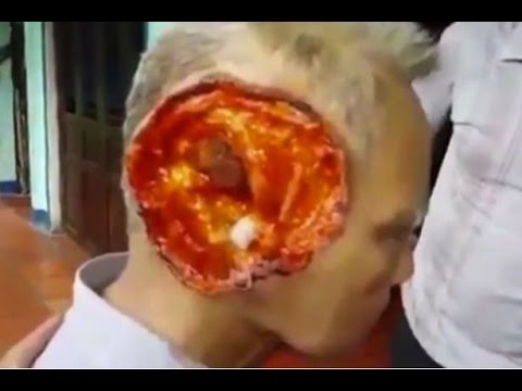 بالفيديو فيروس آكل للحوم البشر يلتهم وجه رجل فيتنامي